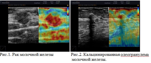 Диагностика рака
